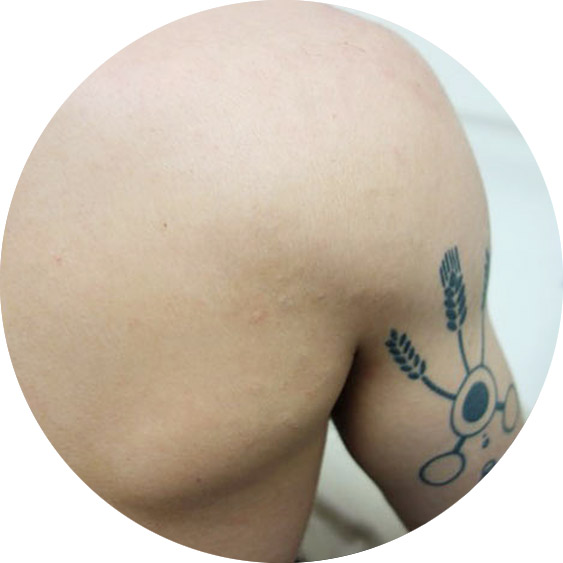 Pico Laser and Tattoo Removal Treatment Auckland  LEXINIC